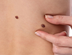 Skin Tag Removal_image